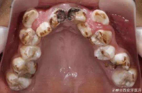 可乐对牙齿的危害是什么呢？