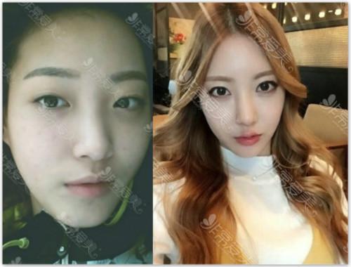 韩国割双眼皮医生排名 韩国双眼皮修复医生推荐